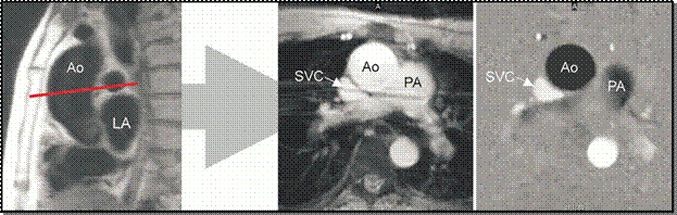 http://radiographics.rsna.org/content/22/3/651/F29.large.jpg