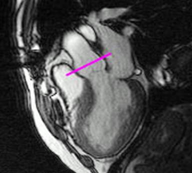 http://radiographics.rsna.org/content/23/1/e9/F18.large.jpg