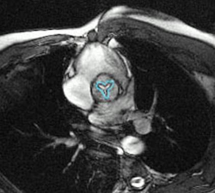 http://radiographics.rsna.org/content/23/1/e9/F21.large.jpg